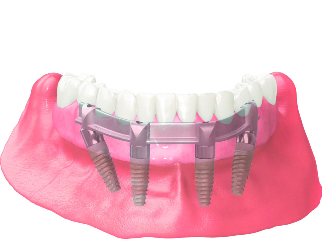 All-On-® Implant Dentures