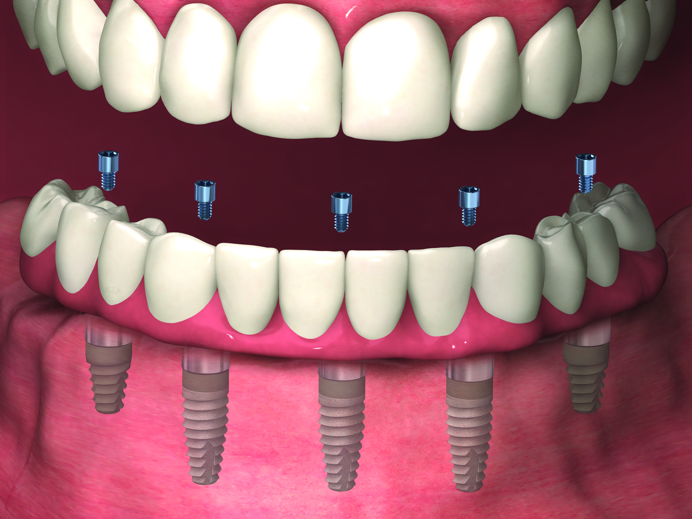 Rebuilding Your Complete Dental Arch Midlothian, TX