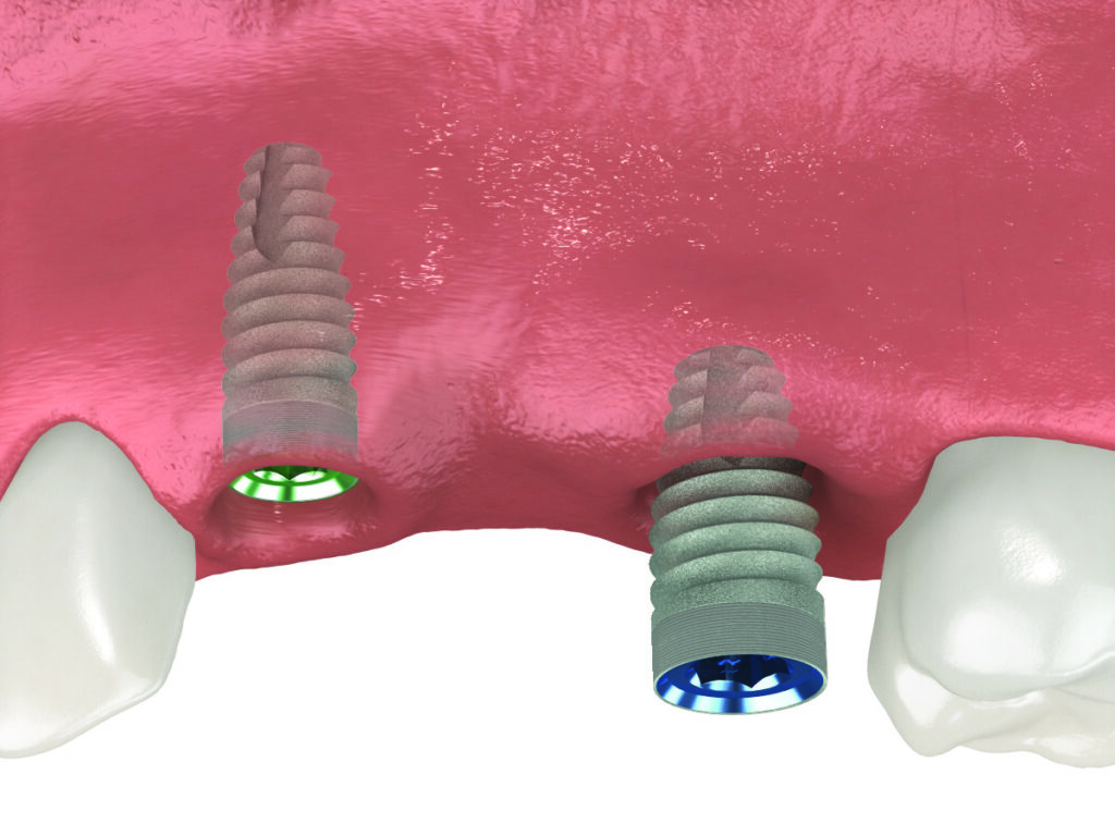 Keeping Dental Tools Clean In COVID-19 Midlothian, Dental Safety