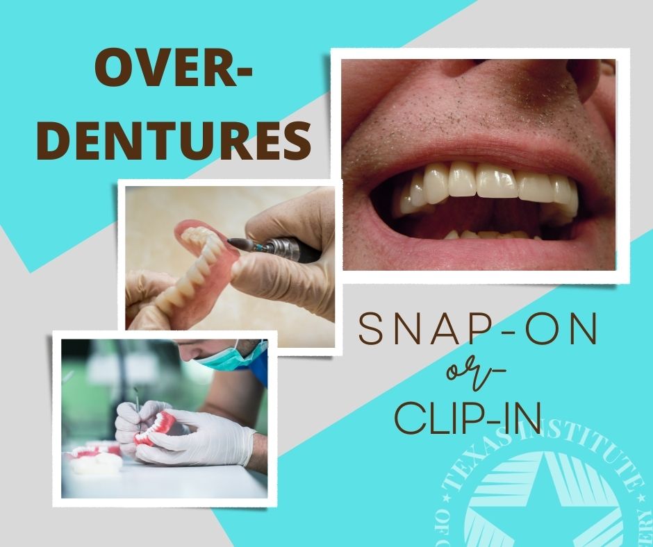 implant overdentures