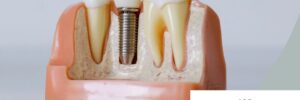 single dental implant treatment